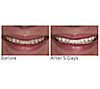Supersmile The Works + Whitening PreRinse, 1 of 5