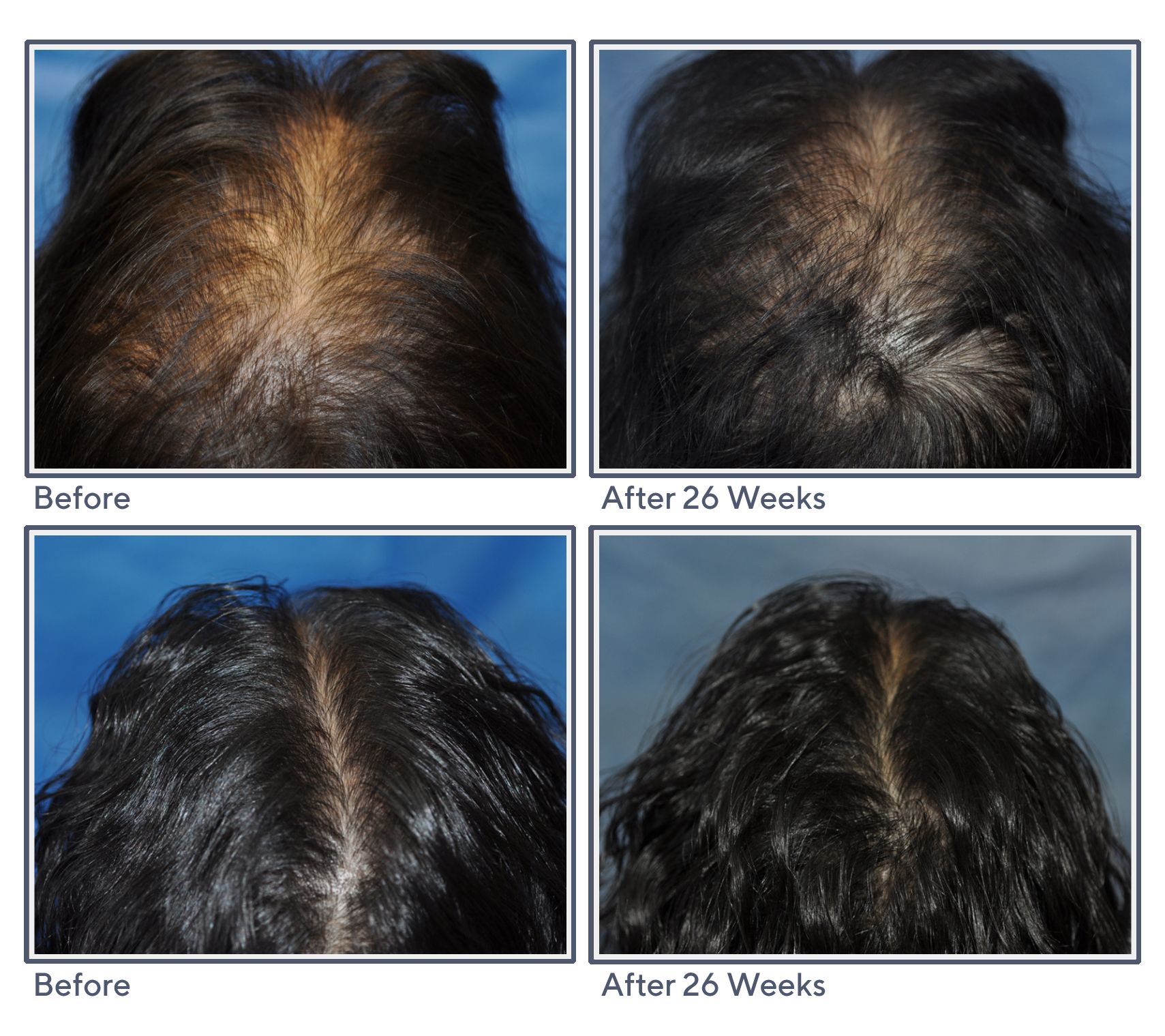 Hair Loss: Sasha Advanced Treatments To Stop Hair Loss and Boost Hair Growth