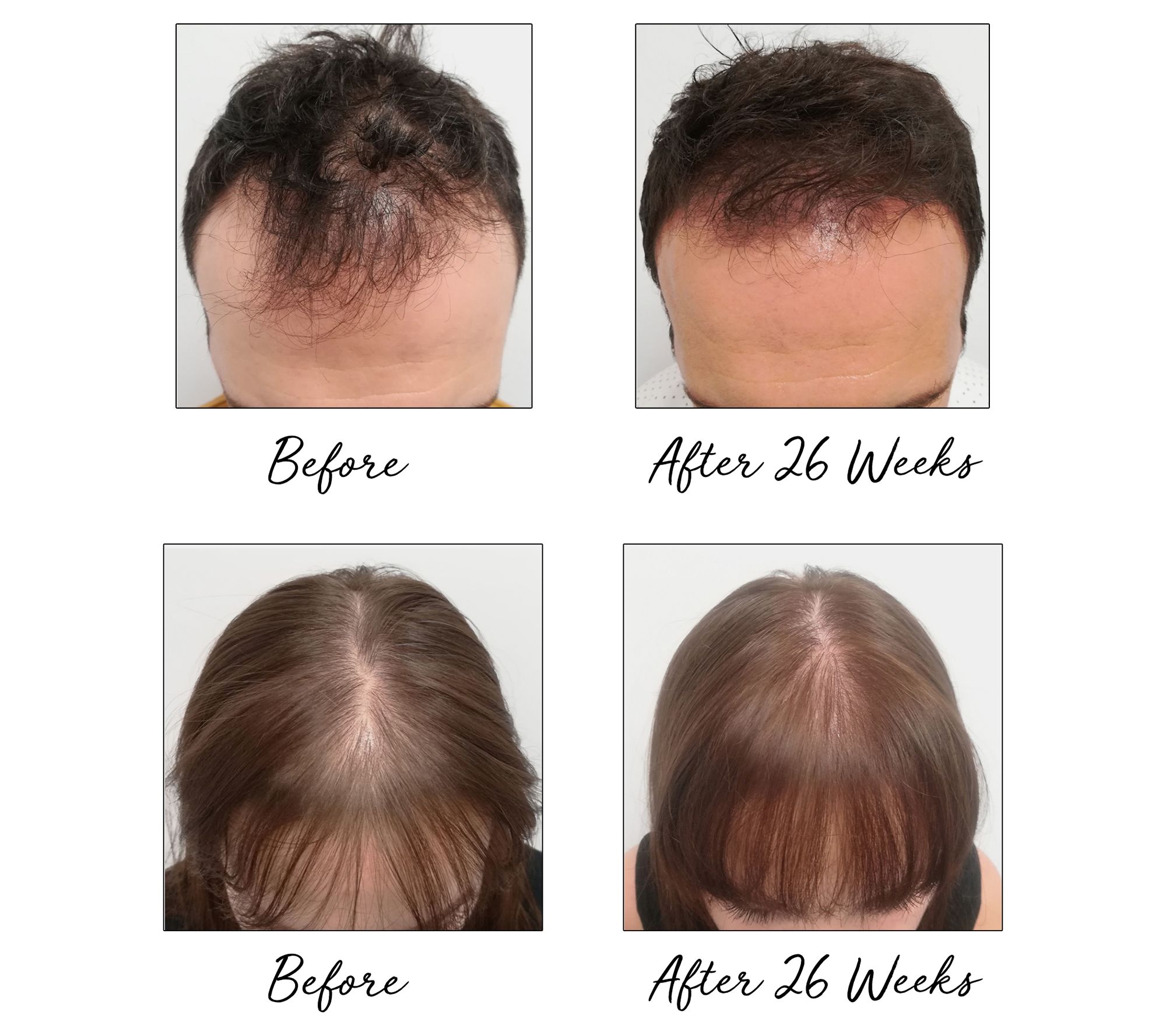 (QVC) HairMax PowerFlex Laser Cap 202 Hair Growth Device