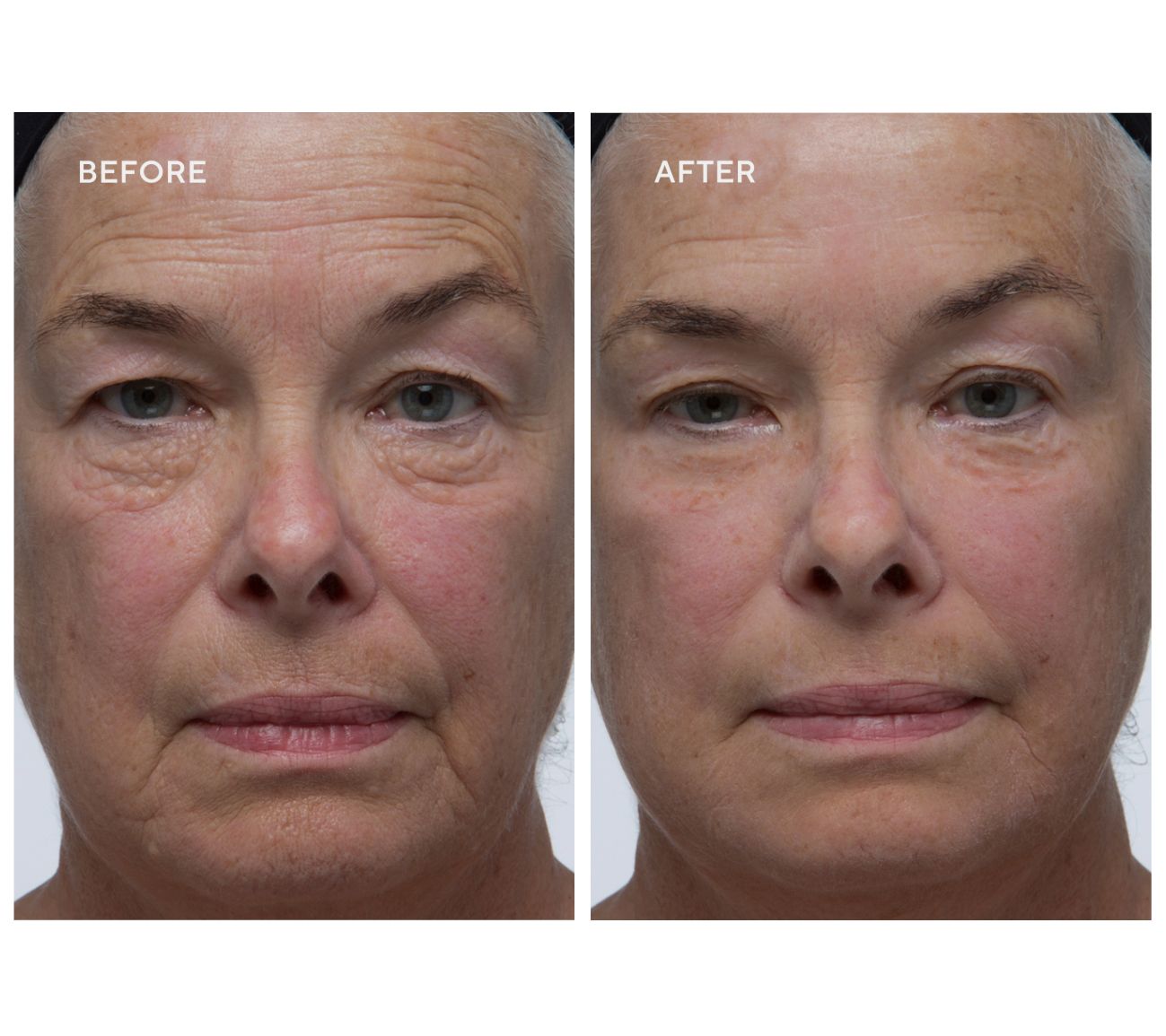 Dr. Denese Wrinkle Lost 3 Minute Wrinkle Reducer 1-oz Trio | QVC
