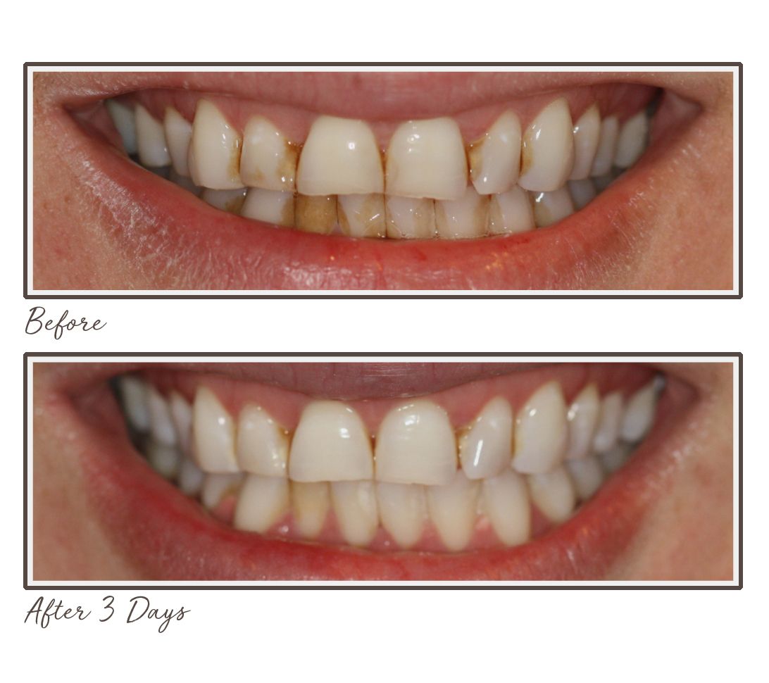 Smileactives MegaSize Power Teeth Whitening 7.6 oz Gel Duo