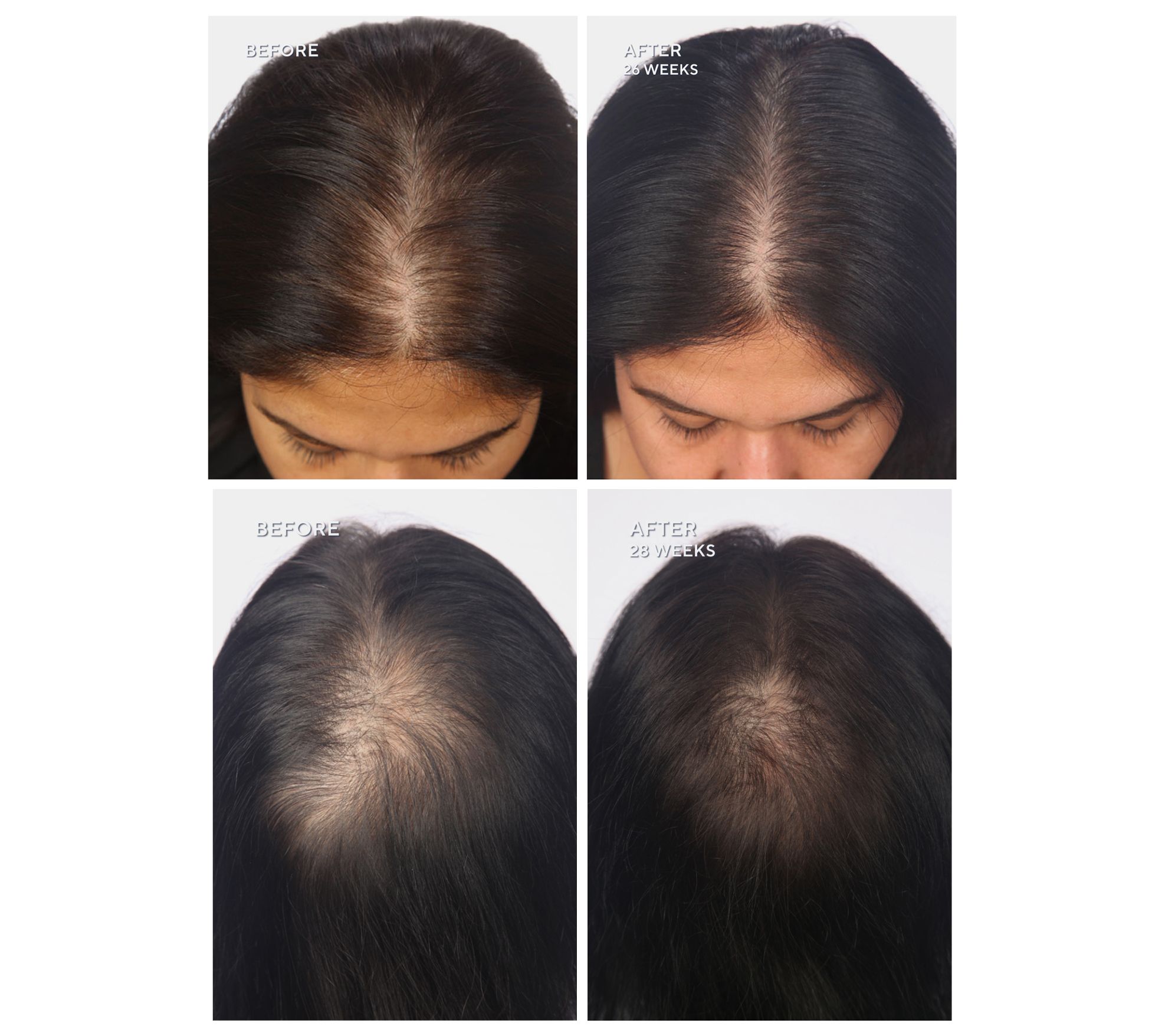 Hairmax LaserBand 82 ComfortFlex Hair Growth Device - QVC.com