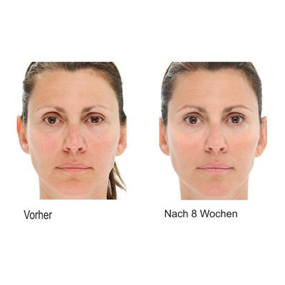 LIGHTSTIM Anti Aging Licht Therapie gegen Falten alle Hauttypen 
