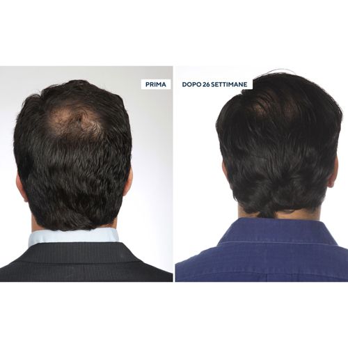 Hairmax Pro 12 Spazzola laser promuove la crescita dei capelli QVC Italia