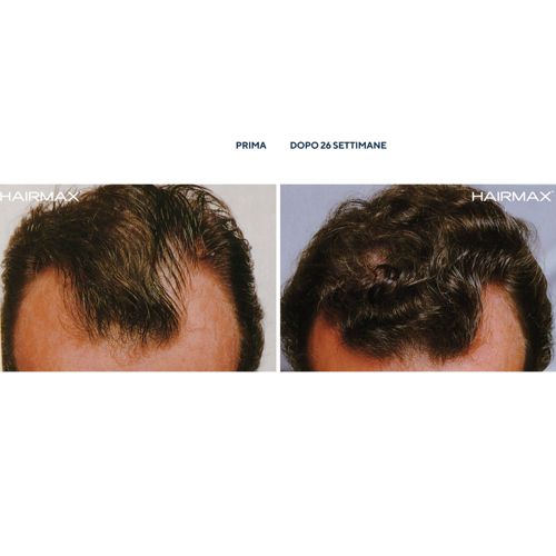 Hairmax Pro 12 Spazzola laser promuove la crescita dei capelli QVC Italia